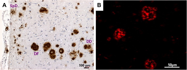 Graphical abstract of the publication entitled 'The binding affinity of anti-A beta 1-42 MAb-decorated nanoliposomes to A beta 1-42 peptides in vitro and to amyloid deposits in post-mortem tissue'